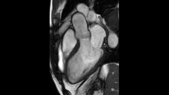 BTFE left ventricular outflow tract