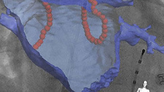 cardiac arrhythmias desktop