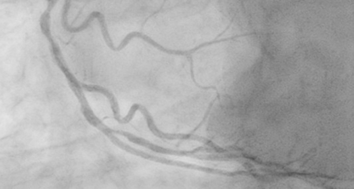 Treating coronary artery disease