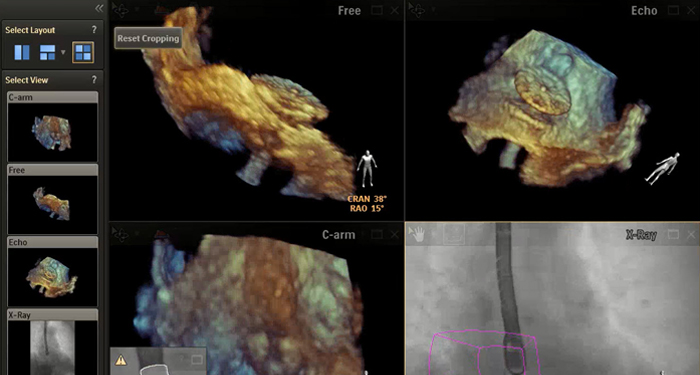 Structural heart disease