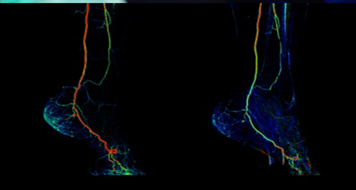 Endovascular/oncology therapy